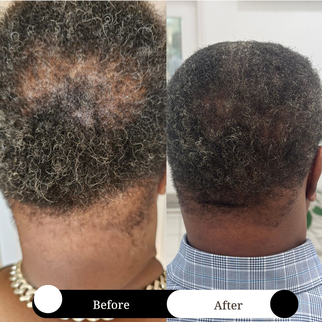 SET OF 4 - Hair Loss Recovery for Men Travel Size